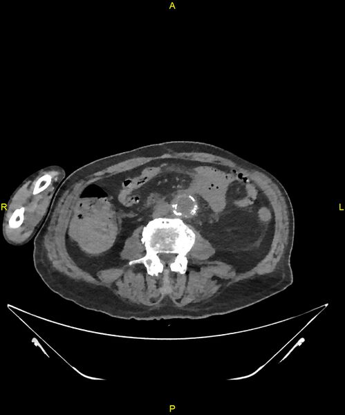 File:Aortoenteric fistula (Radiopaedia 84308-99603 Axial non-contrast 205).jpg