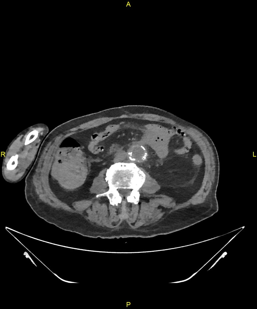 Aortoenteric fistula (Radiopaedia 84308-99603 Axial non-contrast 205).jpg