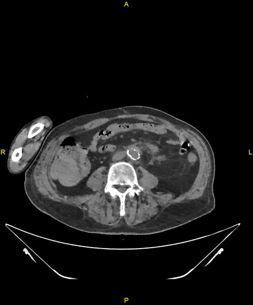 File:Aortoenteric fistula (Radiopaedia 84308-99603 Axial non-contrast 217).jpg