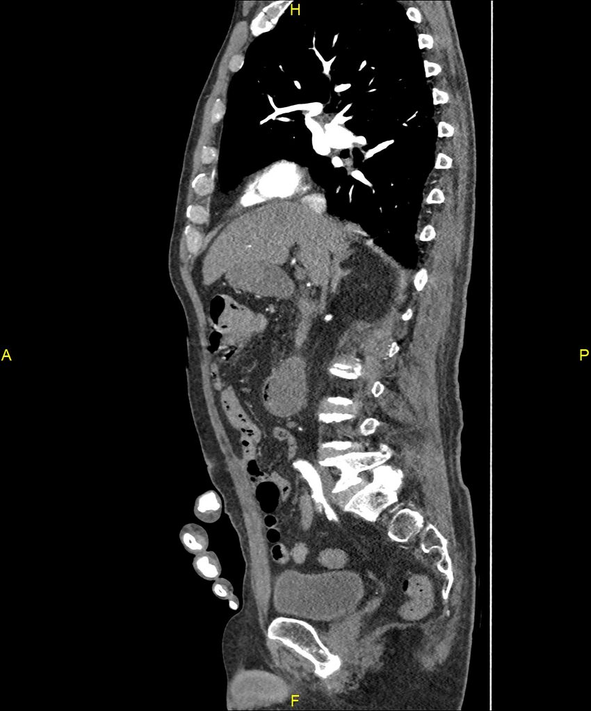 Aortoenteric fistula (Radiopaedia 84308-99603 C 142).jpg