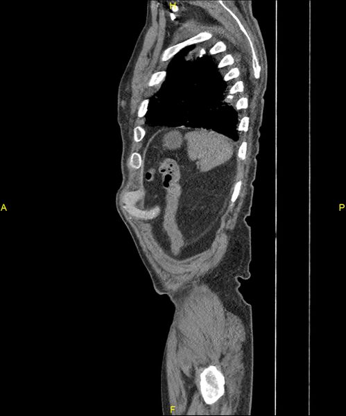 File:Aortoenteric fistula (Radiopaedia 84308-99603 C 302).jpg