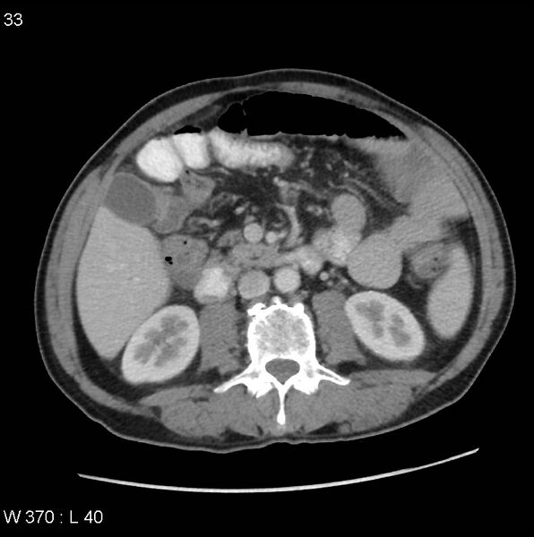 File:Appendicitis (Radiopaedia 27446-27642 A 14).jpg