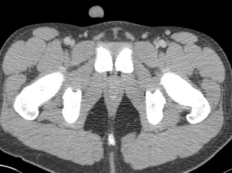 File:Appendicitis and incidental foregut duplication cyst (Radiopaedia 52962-58916 A 108).jpg
