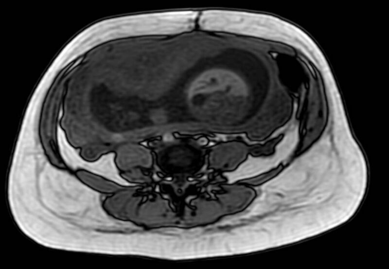 File:Appendicitis in gravida (MRI) (Radiopaedia 89433-106395 D 42).jpg