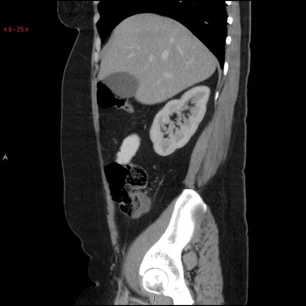 File:Appendicitis with microperforation- promontoric type (Radiopaedia 27268-27442 A 10).jpg
