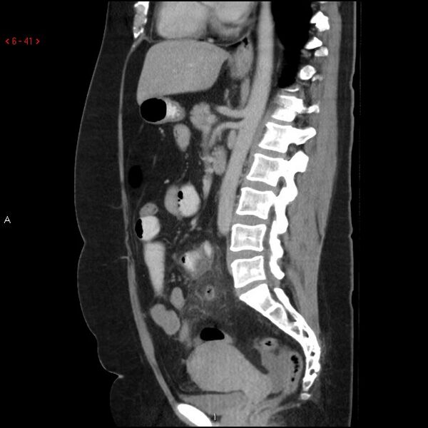 File:Appendicitis with microperforation- promontoric type (Radiopaedia 27268-27442 A 26).jpg