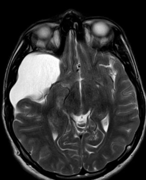File:Arachnoid cyst- extremely large (Radiopaedia 68741-78451 Axial T2 12).jpg