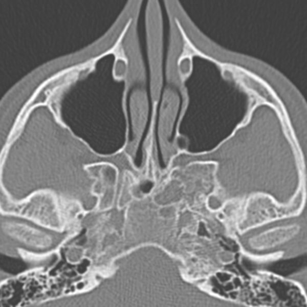 File:Arrested pneumatization of the sphenoid (Radiopaedia 10700-11172 Axial non-contrast 8).jpg