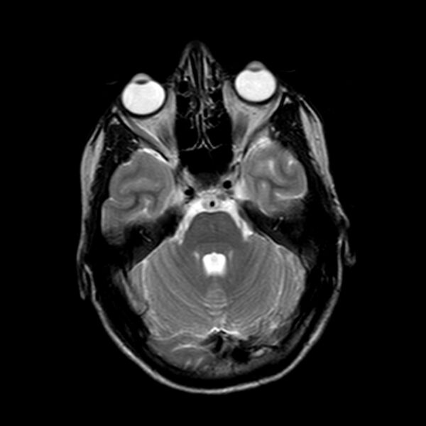 File:Arrested pneumatization of the sphenoid (Radiopaedia 10700-11173 Axial T2 7).jpg
