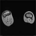 Arthrogryposis and muscle atrophy (Radiopaedia 24081-24313 D 7).jpg
