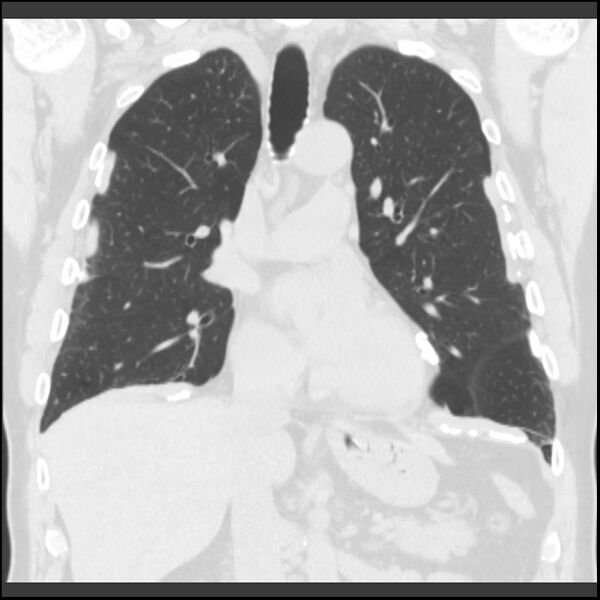 File:Asbestos-related pleural plaques (Radiopaedia 39069-41255 Coronal lung window 50).jpg