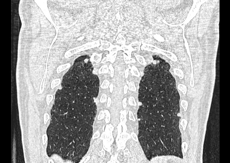 File:Asbestos pleural placques (Radiopaedia 57905-64872 Coronal lung window 257).jpg