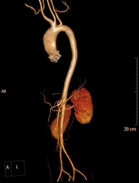 File:Ascending aortic pseudoaneurysm (Radiopaedia 28638-28910 D 28).jpg