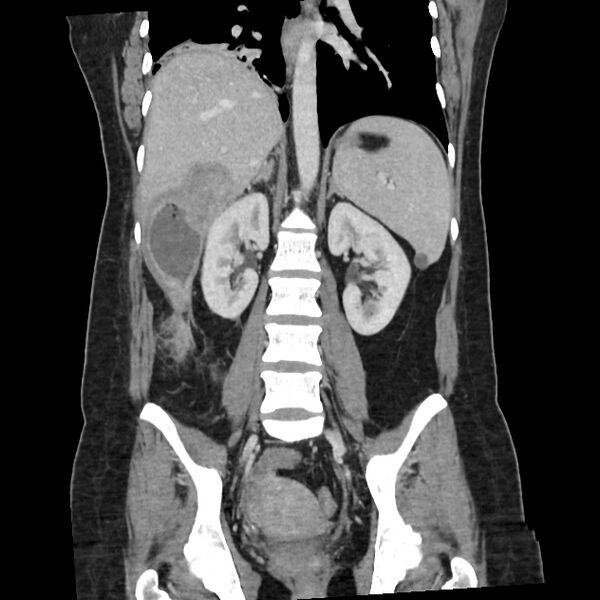 File:Ascending retrocecal appendicitis with liver abscesses (Radiopaedia 60066-67615 C 13).jpg