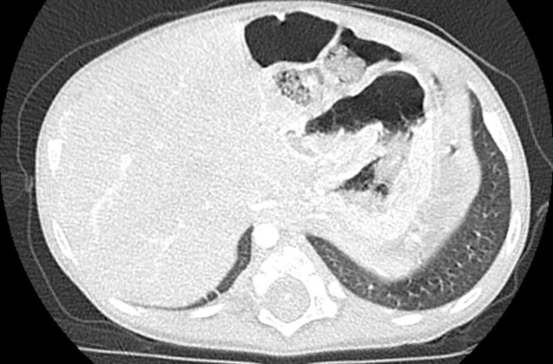 File:Asplenia syndrome (Radiopaedia 73083-83792 Axial lung window 71).jpg