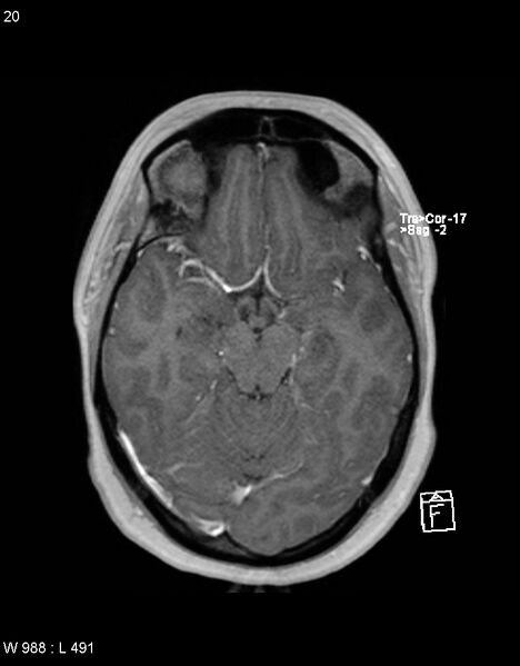 File:Astroblastoma (Radiopaedia 39792-42217 Axial T1 C+ 19).jpg