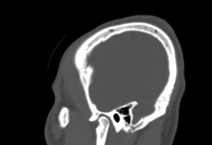 Asymptomatic occipital spur (Radiopaedia 87753-104201 Sagittal bone window 275).jpg