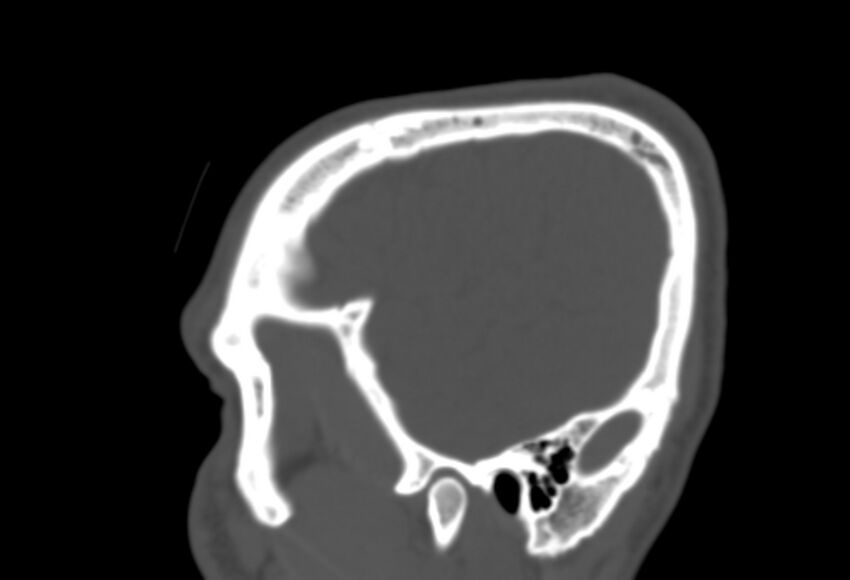 Asymptomatic occipital spur (Radiopaedia 87753-104201 Sagittal bone window 33).jpg
