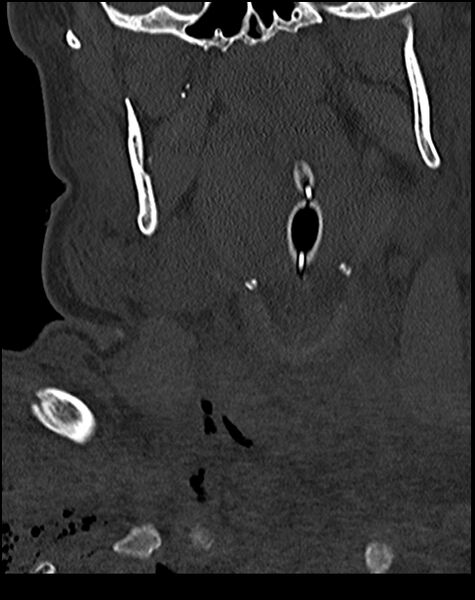 File:Atlanto-occipital dissociation - Traynelis type 1 (Radiopaedia 87570-103948 Coronal bone window 13).jpg
