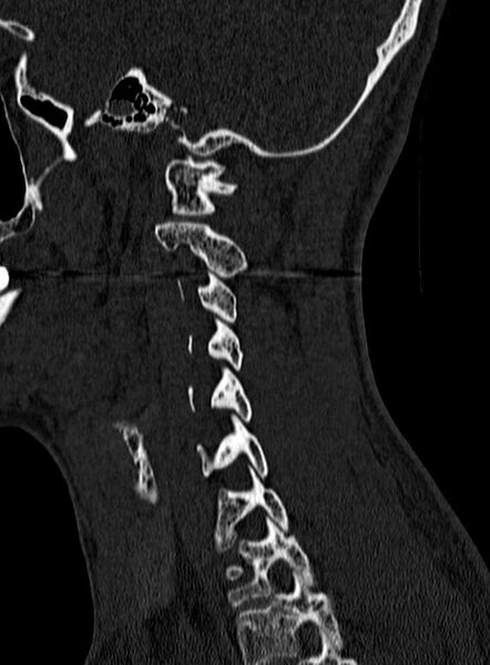 File:Atlantoaxial subluxation (Radiopaedia 44681-48450 Sagittal bone window 128).jpg