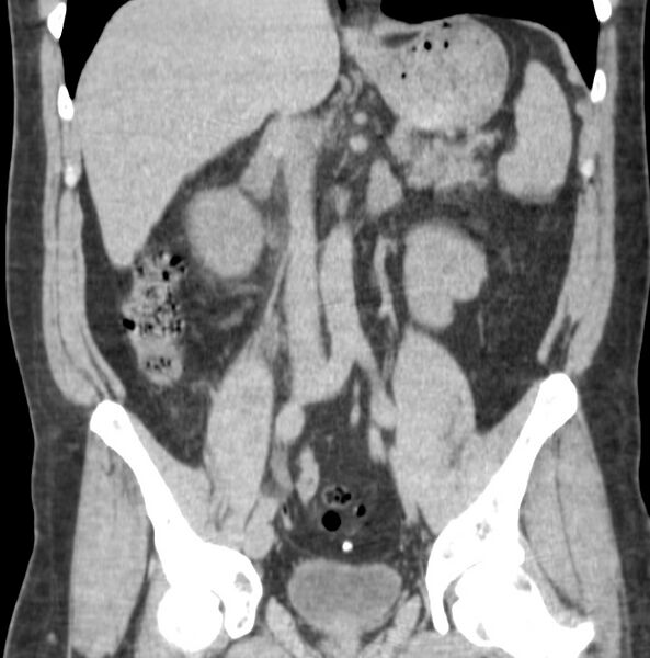 File:Atrophic kidney due to severe chronic obstructive hydronephrosis (Radiopaedia 40828-43474 Coronal non-contrast 1).jpg