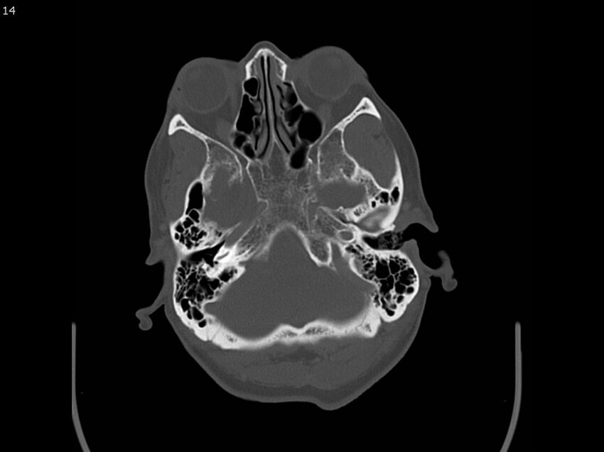 Atypical meningioma - intraosseous (Radiopaedia 64915-73867 Axial C+ bone window 14).jpg