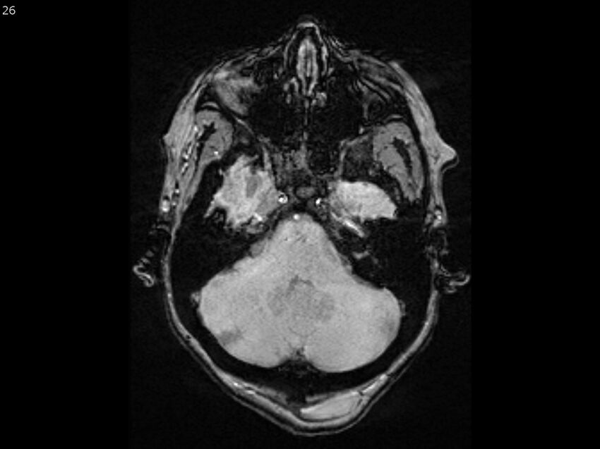 Atypical meningioma - intraosseous (Radiopaedia 64915-74572 Axial SWI 26).jpg