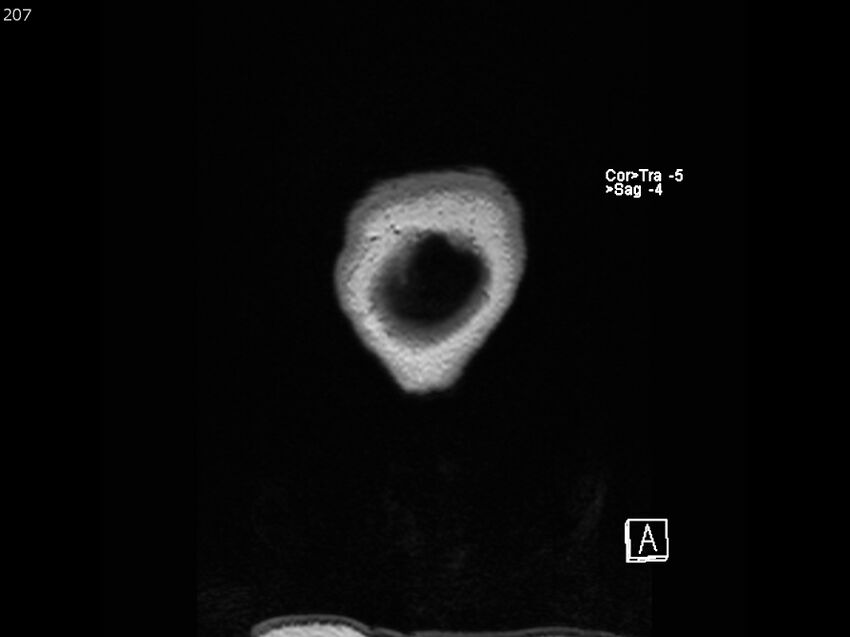 Atypical meningioma - intraosseous (Radiopaedia 64915-74572 Coronal T1 207).jpg