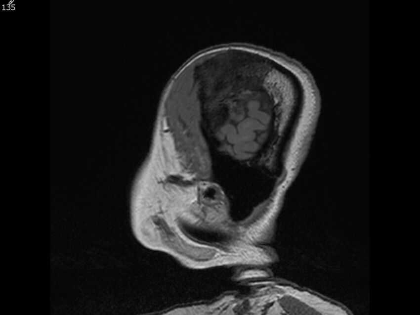 Atypical meningioma - intraosseous (Radiopaedia 64915-74572 Sagittal T1 135).jpg