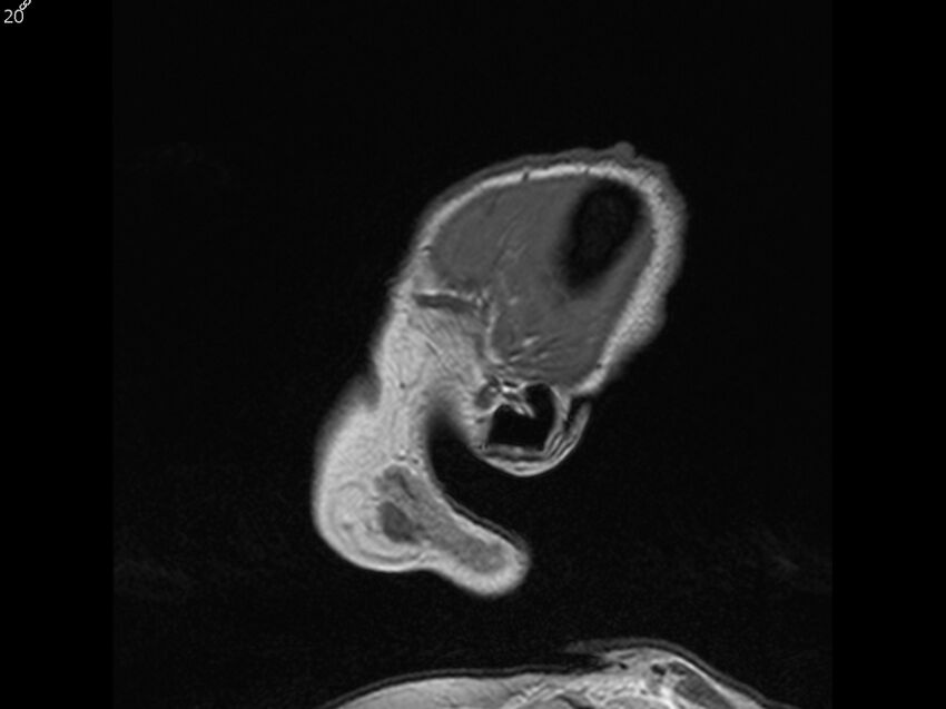 Atypical meningioma - intraosseous (Radiopaedia 64915-74572 Sagittal T1 20).jpg