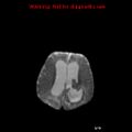Atypical teratoid rhabdoid tumor (Radiopaedia 10712-11183 Axial DWI 6).jpg