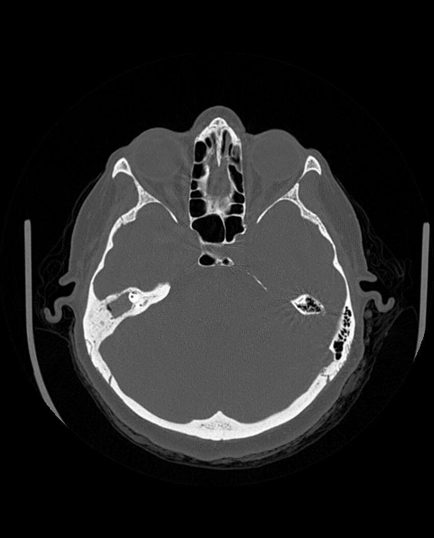 Automastoidectomy with labyrinthine fistula (Radiopaedia 84143-99411 Axial non-contrast 100).jpg