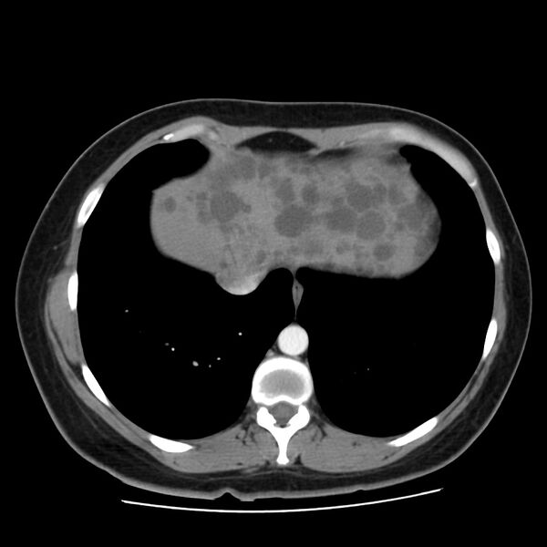 File:Autosomal dominant polycystic kidney disease (Radiopaedia 23061-23093 B 7).jpg
