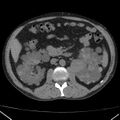 Autosomal dominant polycystic kidney disease (Radiopaedia 36539-38101 Axial non-contrast 37).jpg
