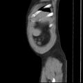 Autosomal dominant polycystic kidney disease (Radiopaedia 36539-38101 D 8).jpg
