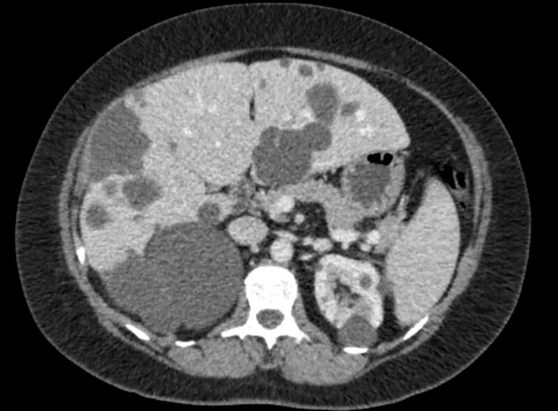 File:Autosomal dominant polycystic kidney disease (Radiopaedia 57124-64017 A 45).jpg
