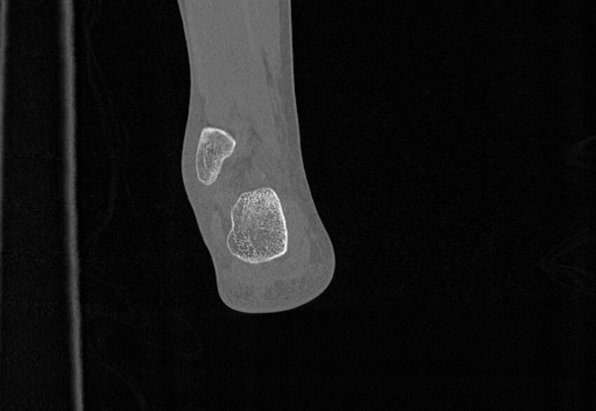 Avulsion fractures of talus and calcaneus (Radiopaedia 48277-53155 Coronal bone window 87).jpg