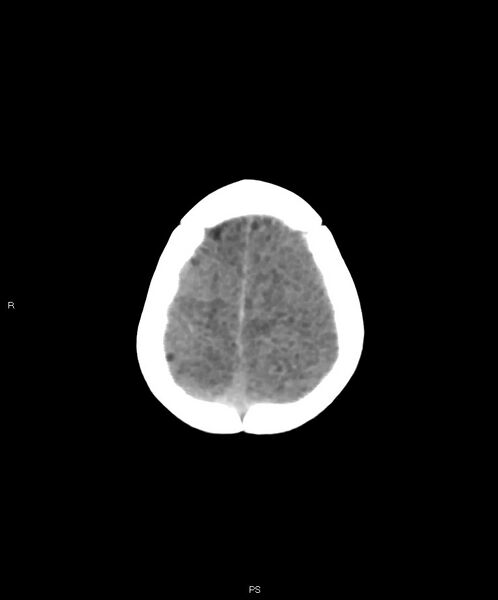 File:Basal ganglia and parenchymal ischemia (Radiopaedia 45818-50083 Axial non-contrast 5).jpg