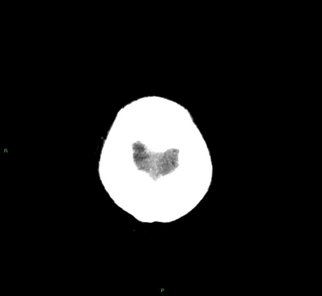 File:Basal ganglia hemorrhage (Radiopaedia 58763-65985 Axial non-contrast 5).jpg