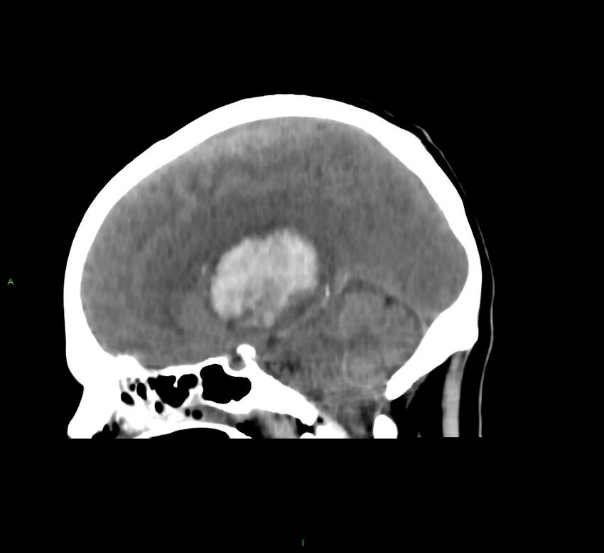 Basal ganglia hemorrhage (Radiopaedia 58775-66008 B 30).jpg