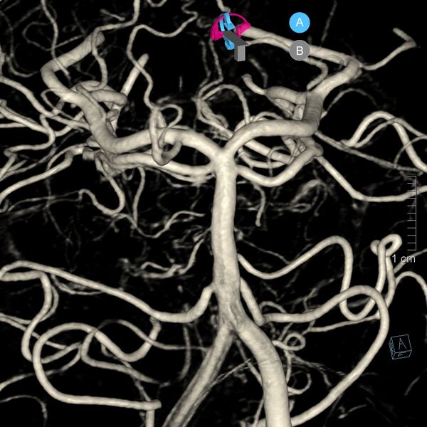 File:Basilar artery perforator aneurysm (Radiopaedia 82455-97734 3D view left VA 45).jpg