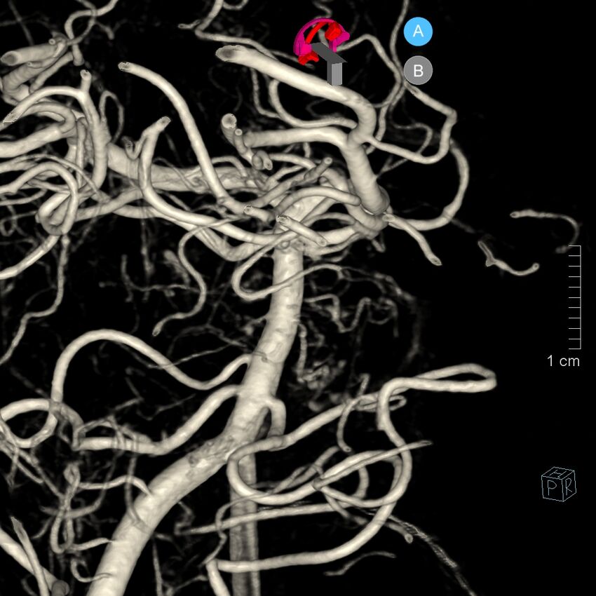 Basilar artery perforator aneurysm (Radiopaedia 82455-97734 3D view left VA 79).jpg