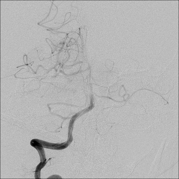 File:Basilar artery thrombosis treated with intra-arterial urokinase (Radiopaedia 34571-35949 B 15).png