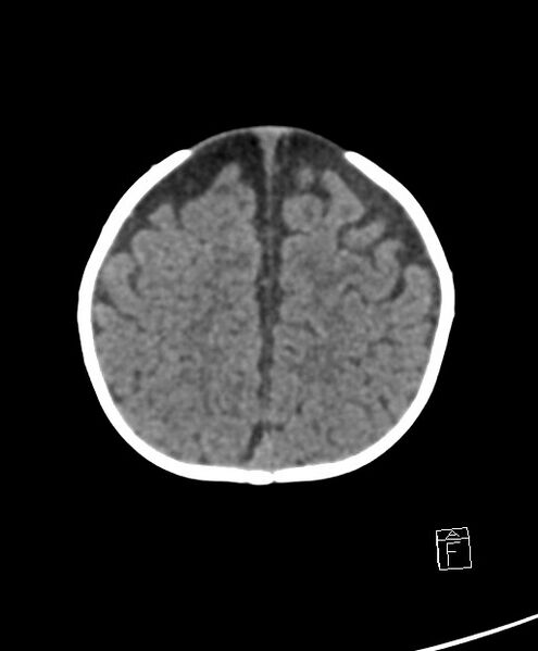 File:Benign enlargement of subarachnoid spaces in infancy (BESS) (Radiopaedia 87459-103795 Axial non-contrast 19).jpg