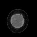 Benign leiomyoma with hydropic features (Radiopaedia 89250-106130 B 10).jpg