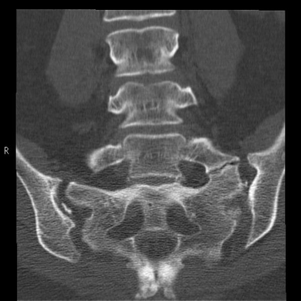 File:Bertolotti syndrome (Radiopaedia 24864-25128 Coronal bone window 27).jpg