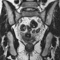 Bicornuate uterus (Radiopaedia 11104-11492 Coronal T2 17).jpg