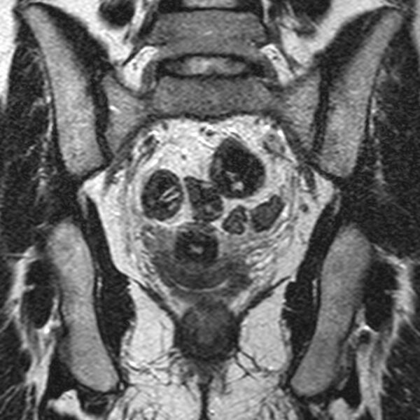 File:Bicornuate uterus (Radiopaedia 11104-11492 Coronal T2 17).jpg