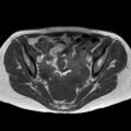 Bicornuate uterus (Radiopaedia 61974-70046 Axial T1 26).jpg