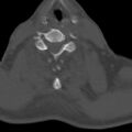 Bilateral C6-7 locked facet dislocation (Radiopaedia 28506-28748 Axial bone window 18).jpeg